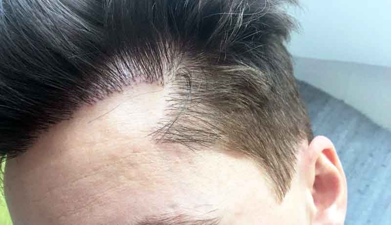 Benefits of Hair Transplant Surgery | Universal Media Forum